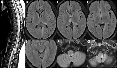 Mirror-Image Lesions in Sequential Relapses of AQP4-Positive Neuromyelitis Optica Spectrum Disorder